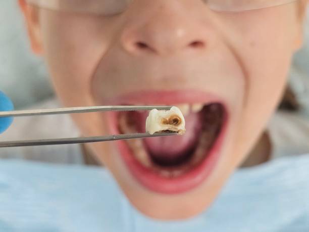 Best Emergency Treatment for Oral Infections in Clearwater, KS